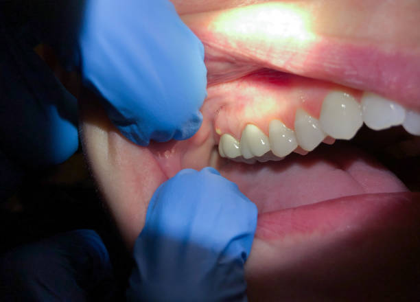 Best Urgent Care for Lost Fillings or Crowns in Spackenkill, NY